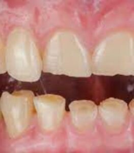 Dentadura con desgaste dental avanzado